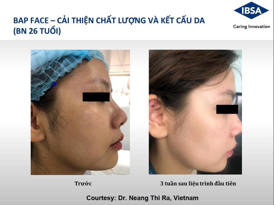 Vai trò của Acid Hyaluronic (HA) trong chăm sóc và trẻ hoá làn da.