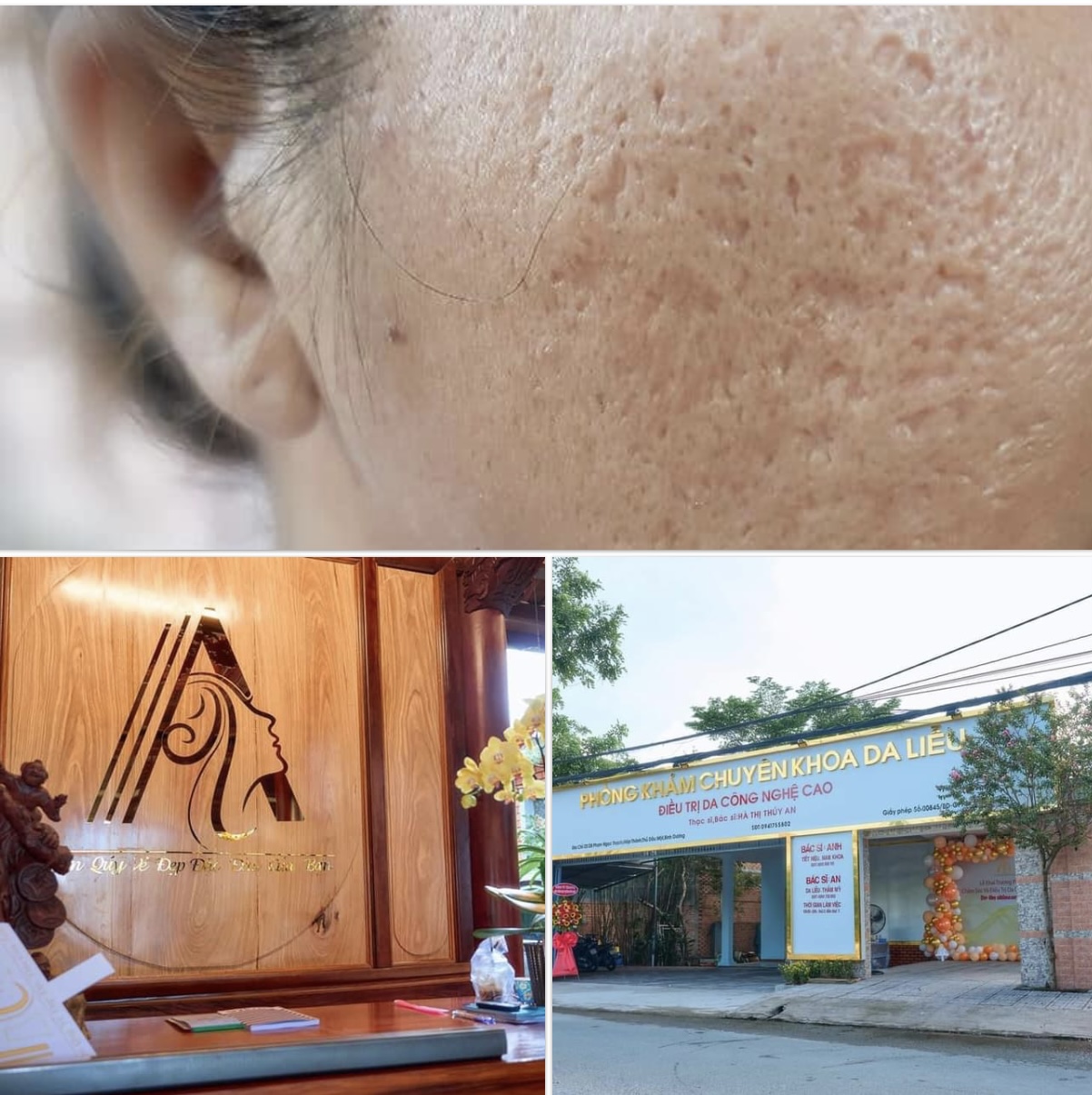 Điều trị sẹo rỗ