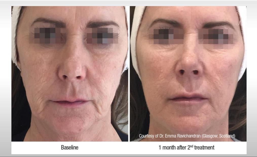 Giải pháp trẻ hoá da bằng sản phẩm Profhilo.