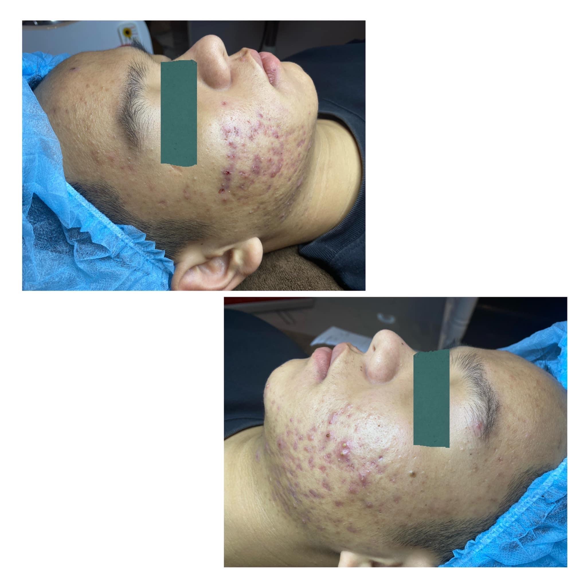 Mụn vấn đề không của riêng ai