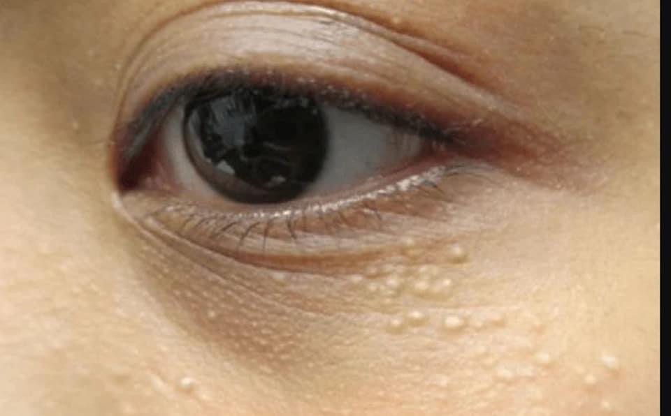 Dấu hiệu nhận biết mụn thịt và cách điều trị